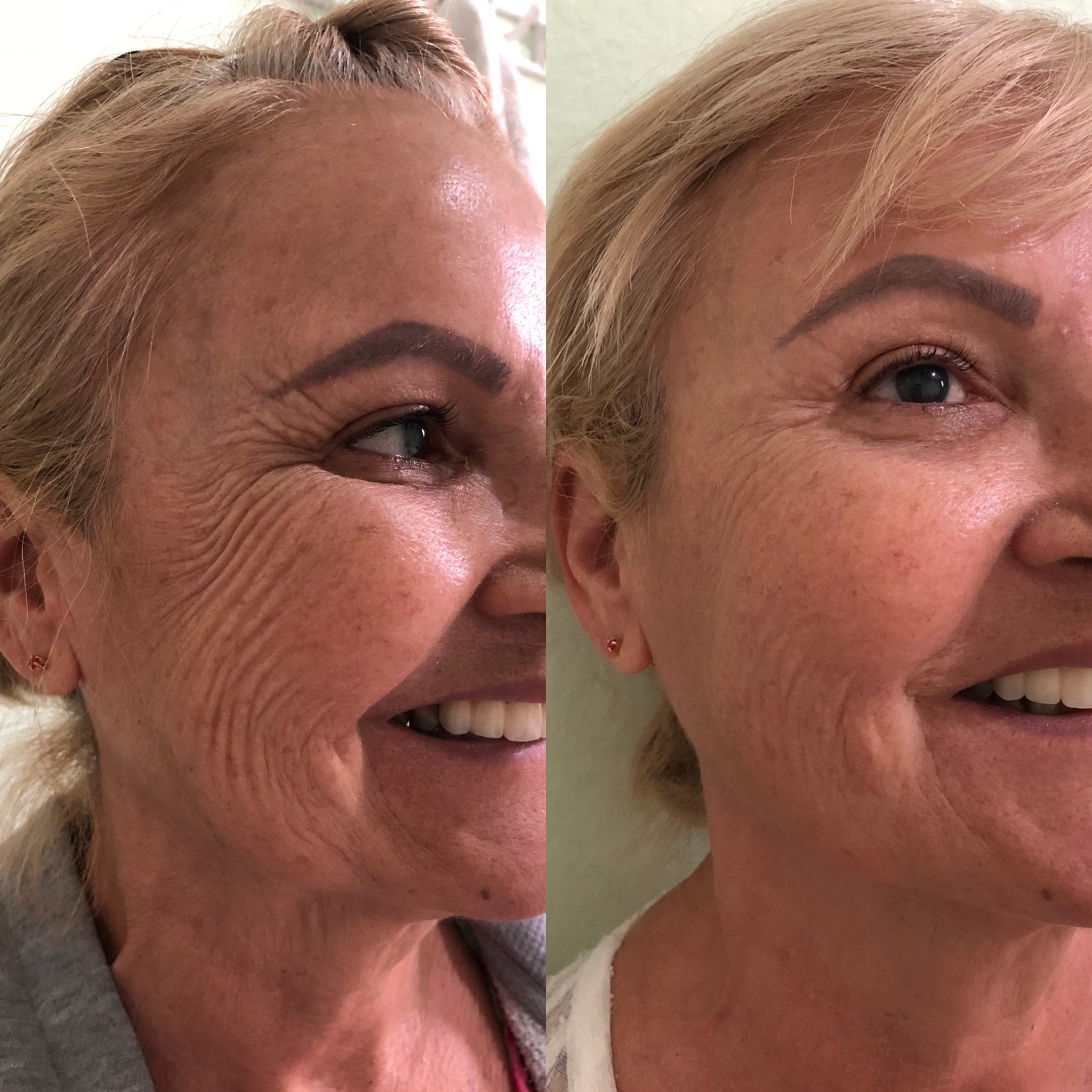 Registro comparativo de antes e depois de bioestimulador de colágeno