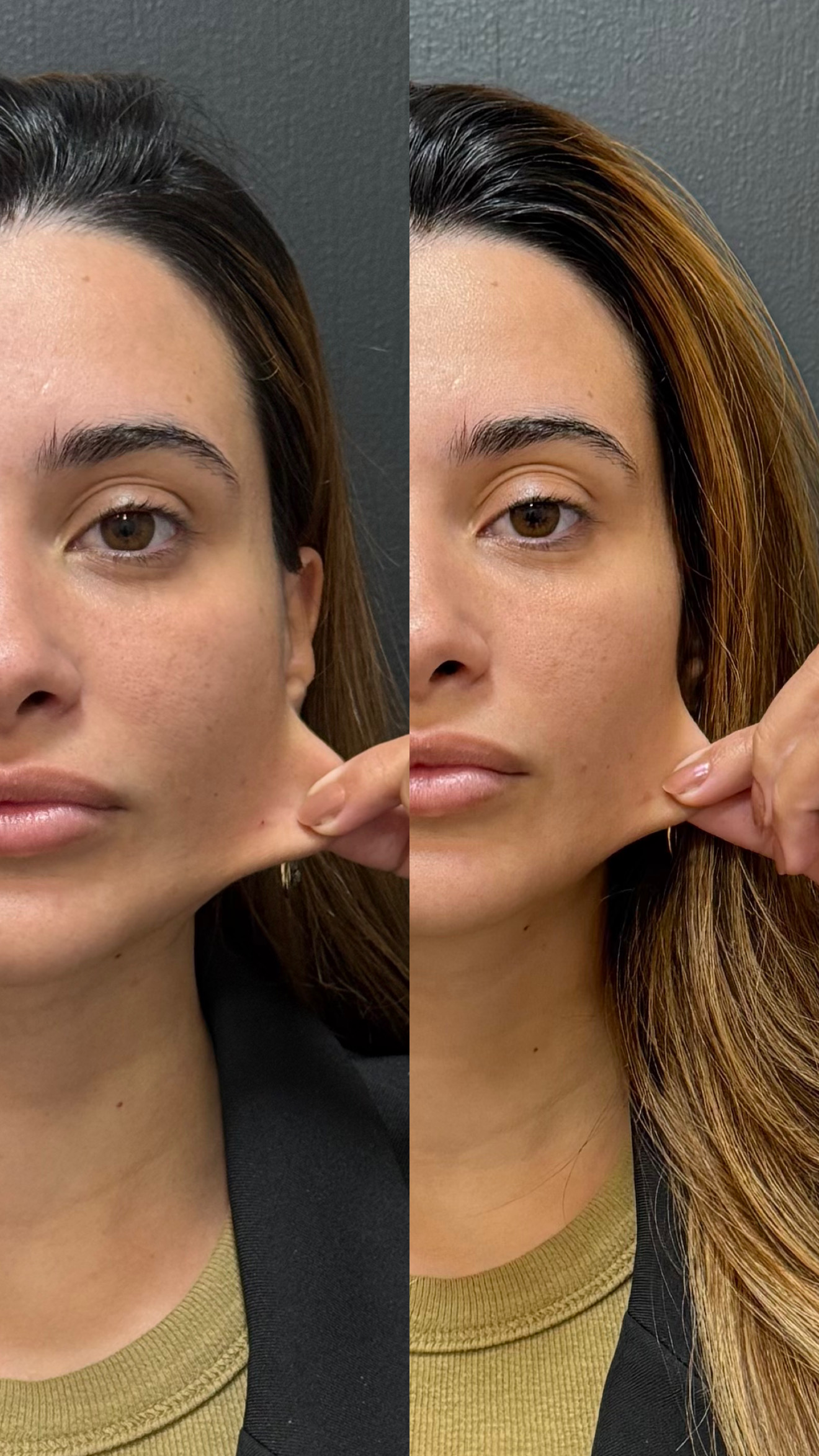 Registro comparativo de antes e depois de bioestimulador de colágeno
