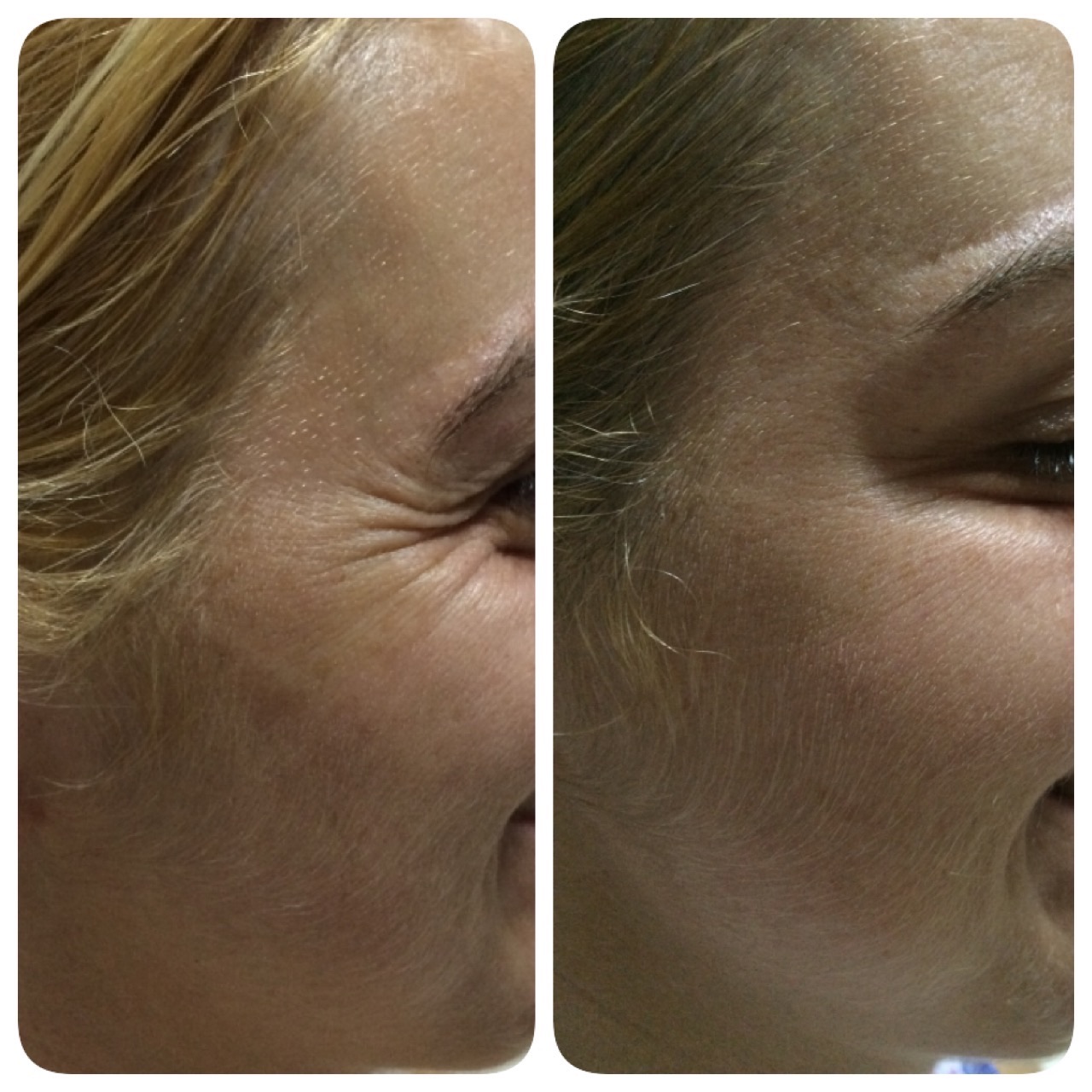 Registro comparativo de antes e depois de toxina botulínica