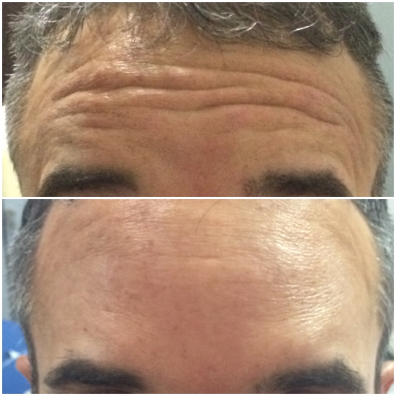 Registro comparativo de antes e depois de toxina botulínica