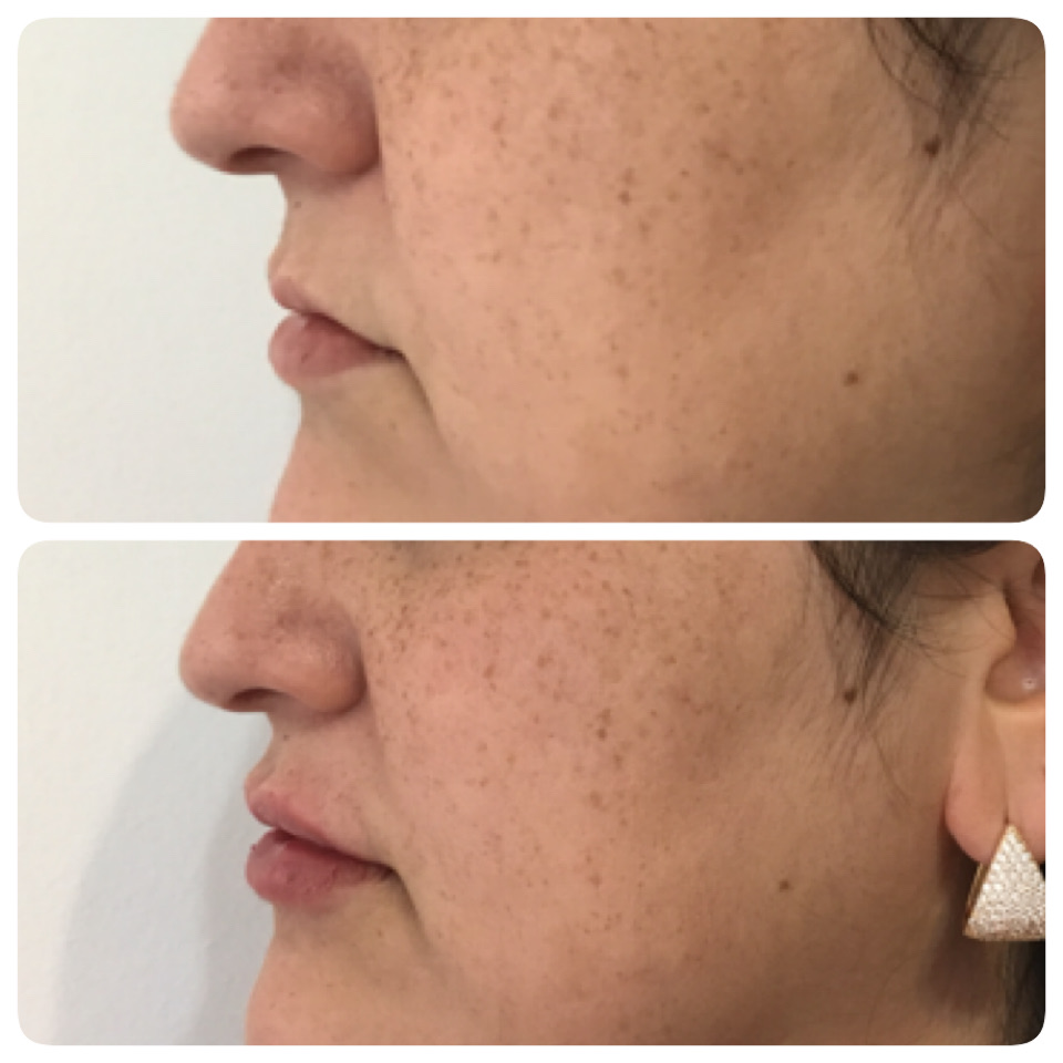 Registro comparativo de antes e depois de preenchimento labial
