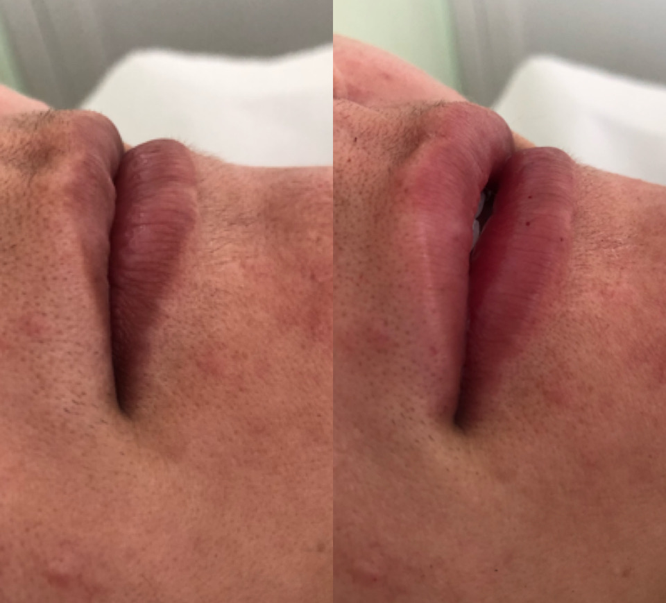 Registro comparativo de antes e depois de preenchimento labial